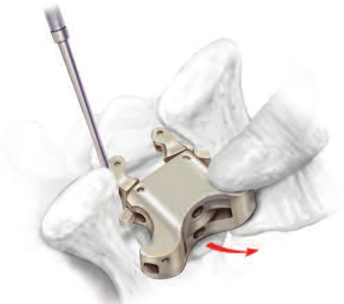 18a) and close (lift) one of the wings of the implant while pulling implant out (Fig. 18b).