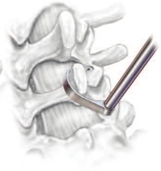 Angled forceps can be used for that purpose.