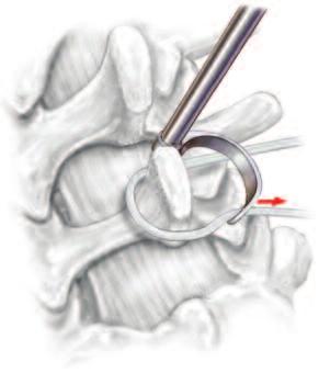 BAND REEVING With the awl passed through the caudal interspinous space, attach one band