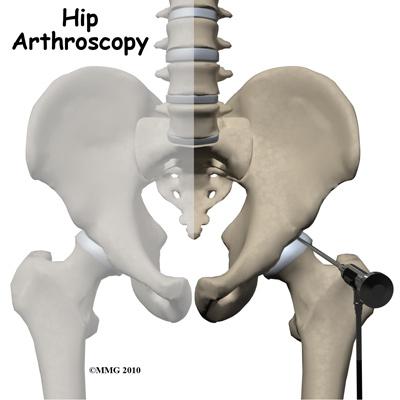 Introduction A hip arthroscopy is a procedure where a small video camera attached to a fiberoptic lens is inserted into the hip joint to allow a surgeon to see without making a large incision.
