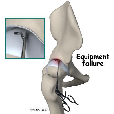 Different types of surgical devices (screws, pins, and suture anchors) are used to hold tissue in place during and after arthroscopy. These devices can cause problems.