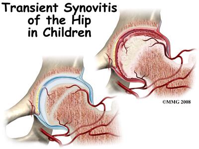 Introduction Transient synovitis of the hip is an acute inflammatory condition of the inner lining of the hip. Transient means it is temporary and doesn t last long.