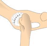 Hip Luxation Treatment Open reduction = surgical reduction of the luxation (1)
