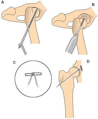 Hip Luxation Treatment (2) Toggle Pin Drill hole through femoral head Drill hole through acetabulum Use toggle pin