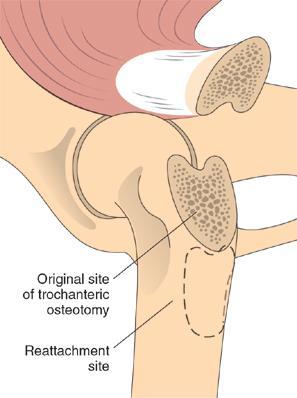 Hip Luxation Treatment (4) Greater Trochanter Translocation Trochanteric osteotomy.
