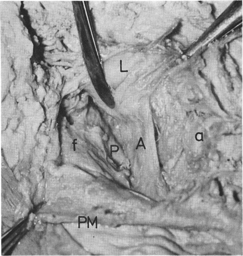 SURGICAL SIGNIFICANCE OF THE ANGULAR TRACT 117 FIG. 1. A dissection showing the angular tract (A).