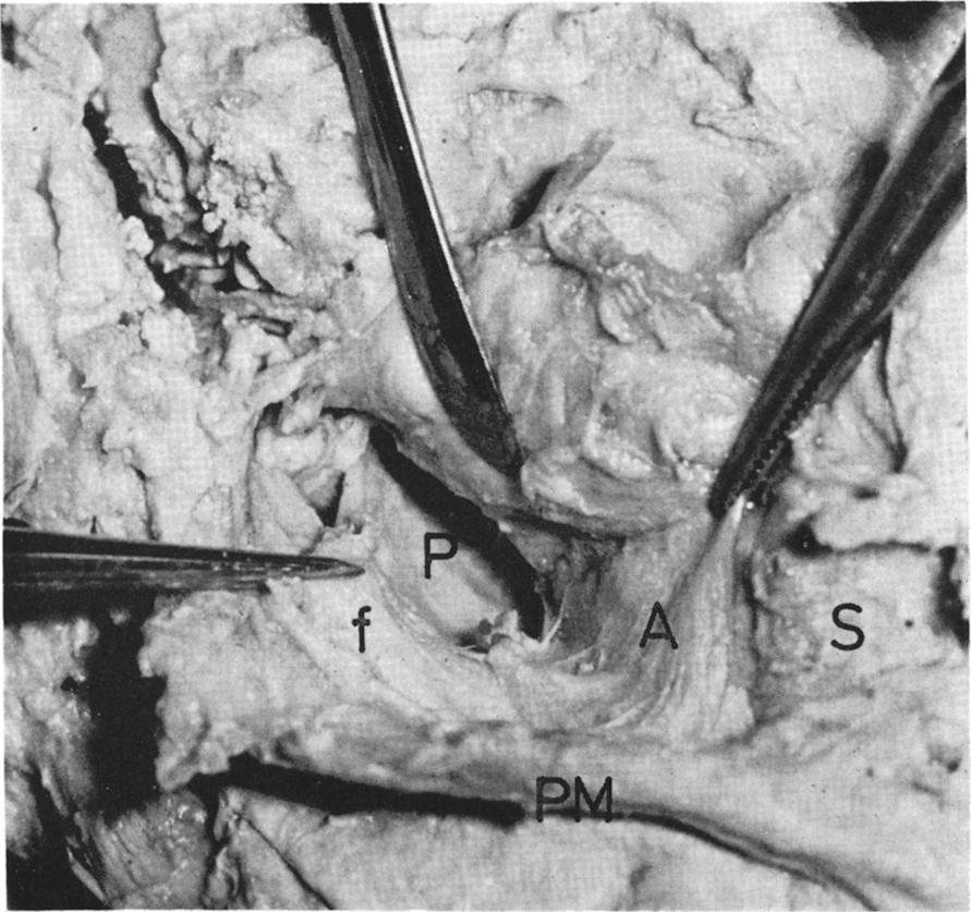 118 BRITISH JOURNAL OF ORAL SURGERY FIG. 2. Another dissection showing the angular tract (A) separating the parotid compartment (P) from the posterior part of the submandibular gland (S).