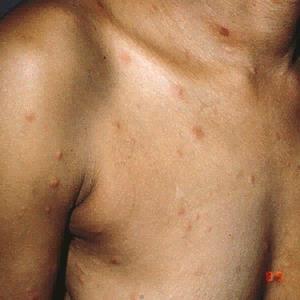 Secondary Syphilis rash can