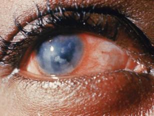 Ocular Syphilis Uveitis, chorioretinitis, retinal vasculitis, optic neuritis/atrophy, keratitis Prevalence unclear; uveitis in 4-9% in secondary stage in some series MAY be more common in HIV+ than
