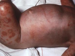 Congenital Syphilis Miscarriage (25%) Neonatal death (25%) Early or late