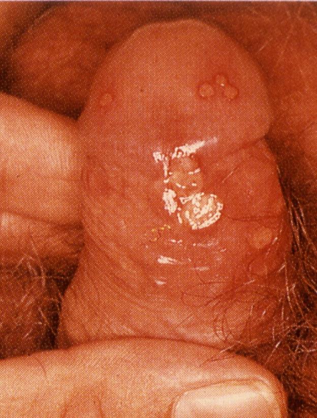 Herpes Simplex Type 1 usually oral, type 2 usually genital But genital disease increasingly is type 1 US adult HSV-2 Seroprevalence (NHANES): 17% More prevalent in women, minorities, older
