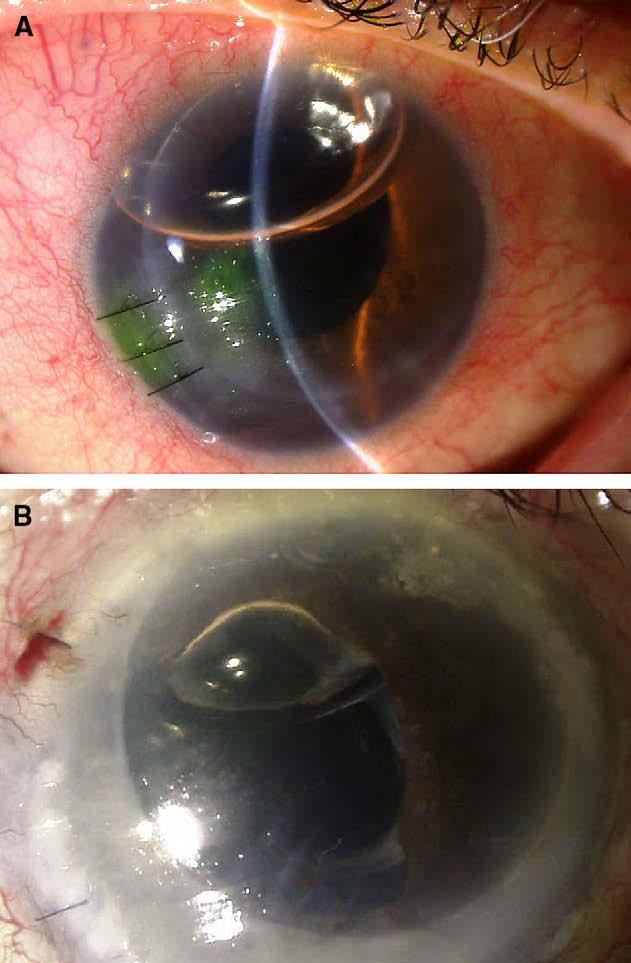 516 Optometry, Vol 80, No 9, September 2009 Figure 2 Expected postoperative improvement of BCVA over time in terms of MAR acuity.