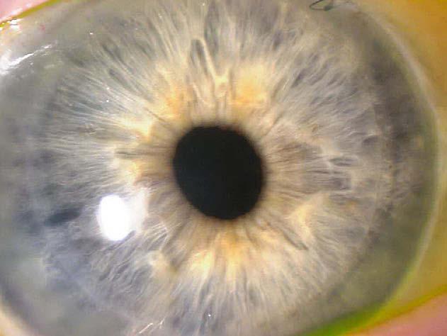 Kathryn Mau Literature Review 517 Figure 3 Slit lamp photo of an eye 1 month s/p DSAEK. The lenticule is securely attached, with a clear cornea showing no signs of edema.