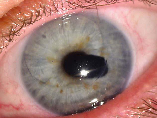 518 Optometry, Vol 80, No 9, September 2009 Figure 4 A, Slit lamp photograph of a dislocated lenticule s/p DSAEK seen on postoperative day 1.