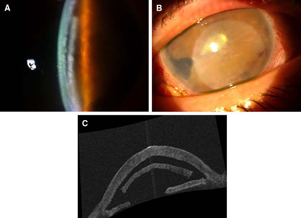 B, Slit lamp photograph of the same patient demonstrating the edematous overlying corneal stroma, the consequence of a dislocated lenticule.