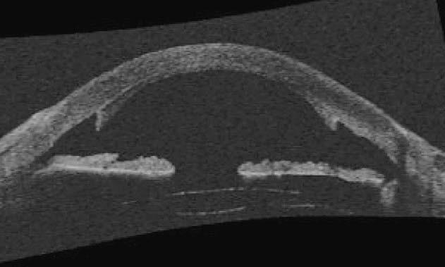 Kathryn Mau Literature Review 519 Figure 6 Anterior chamber OCT of an eye s/p DSAEK demonstrating the concave shape of the lenticule.