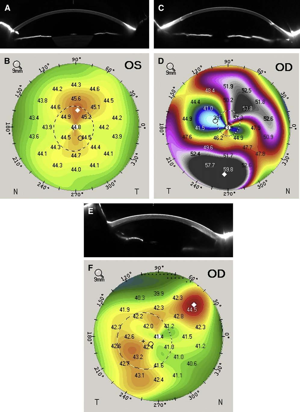520 Optometry, Vol 80, No 9, September 2009 Figure 7 Scheimpflug images and topographies taken from an Oculus Pentacam corneal topography system. A, B, Virgin eye with mild with the rule astigmatism.