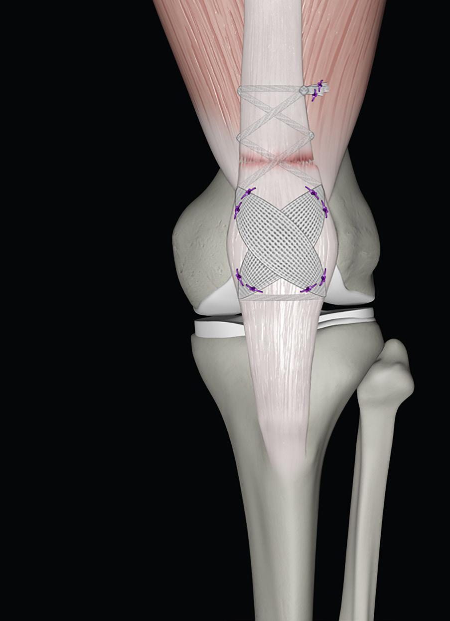 INDICATIONS The QuadsTape and PatellarTape Systems are indicated for patients requiring quadriceps and patellar tendon reconstructions respectively.