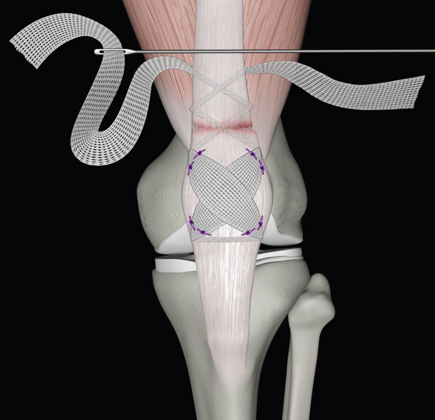 3 4 5 The probe is used to weave the Poly-Tape through the proximal end of the quadriceps tendon and musculature in a Bunnell fashion.