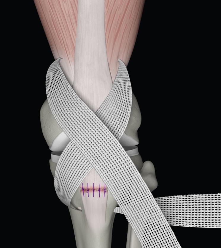 Adequate exposure is essential and should provide sufficient access for the proximal and distal placement of the prosthesis.