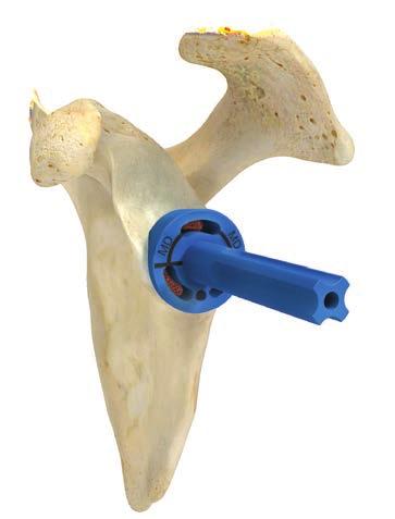 9 Comprehensive Reverse Shoulder System Augmented Baseplate Surgical Technique Addendum Figure 9a