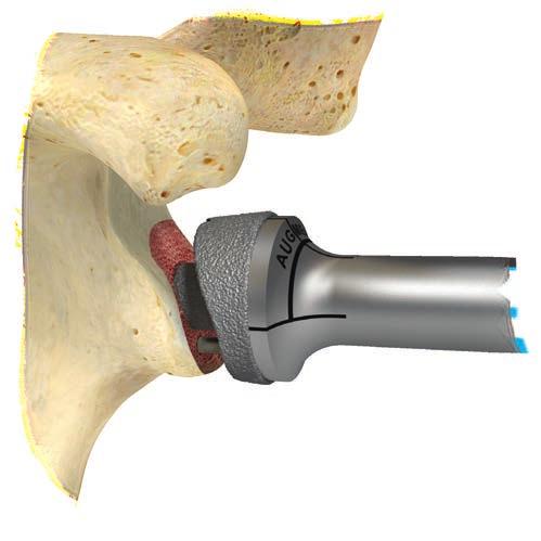 10 Comprehensive Reverse Shoulder System Augmented Baseplate Surgical