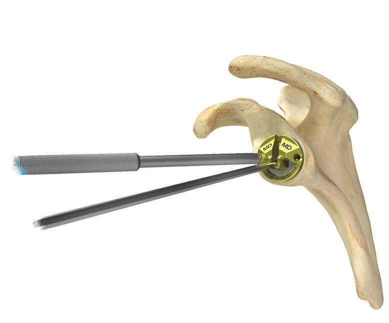 2 mm Steinmann pin into the glenoid at the desired angle and position, ensuring the pin engages or perforates the medial cortical wall (Figure 1).
