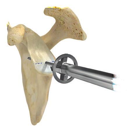 5 Comprehensive Reverse Shoulder System Augmented Baseplate Surgical Technique Addendum Figure 2 Figure 3 High Side Glenoid Preparation The glenoid is prepared in two stages.