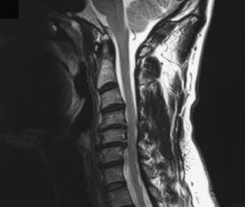 CERVICAL SPONDYLOTIC MYELOPATHY McCORMICK AND COLLEAGUES Ventral spinal cord compression Degenerative osteophytosis of the uncovertebral and facet joints Hypertrophy of the ligamentum flavum and