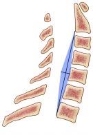 Spine configuration dictates surgical approach Lordosis Kyphosis Straight (dorsal approach indicated) (ventral approach indicated) (dorsal or ventral approach indicated) C2 C7 CCF 2003 FIGURE 2.