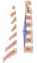 If the kite is completely dorsal to the vertebral bodies, the spine is in lordosis, and a dorsal surgical approach is indicated (left).