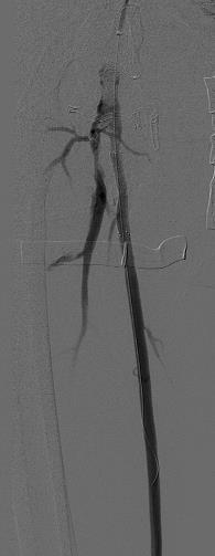 Angioplasty Cross-over access to the