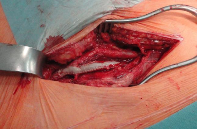 groins sterile prepared Endarteriectomy of right