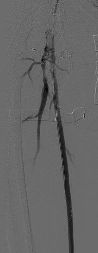 Angioplasty Cross-over access to the
