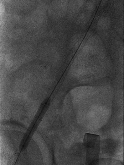 Technical Synopsis We try to place the stents in the distal external iliac artery only AFTER CFA endarterectomy and patchplasty