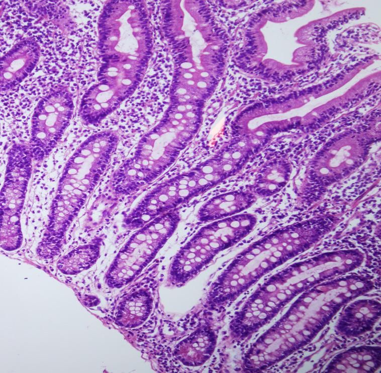 CD3 immunohistochemistry was used when the count was difficult or in doubt.