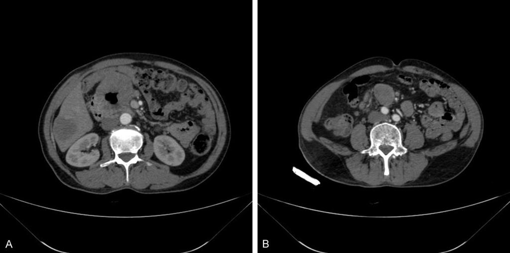 Figure 1. Case 3. 75/M, Computed tomography of primary duodenum GIST and metastases.