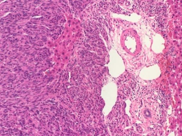 Figure 3. Histopathological appearance of the liver metastasis. The tumor cells infiltrated the hepatic lobule and portal area. (Hematoxylin and eosin stain, 200). Figure 5.
