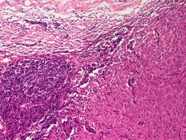 Histopathological appearance of LNM. It was visible that invasive spindle tumor cells presented under capsule of lymph node and there was some residual lymphoid tissue on the left.
