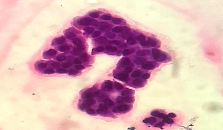 reactive mesothelial cells that are often confused with adenocarcinoma cells in cytopathology. (Figure 1 and Figure 2).