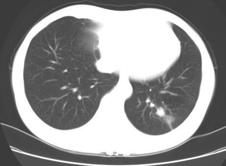 Scan parameters: 120 kv, 100-160mAs, Acquistion matrix 512 512, reconstruction slice thickness 2 mm. The reconstructed images included the lung window and mediastinal window.