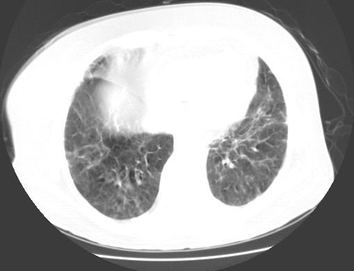 Among these nodules, 15 cases distributed along the beam of bronchial vessels in, 6 cases diffused distribution in both lungs and 8 cases scattered distribution in both lungs.