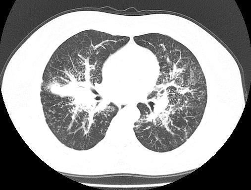 (4.8%) (Figure 5). involvement. Bronchial stenosis Bronchial stenosis was seen in 2 cases (4.8%), with irregular and narrow bronchus (Figure 6).