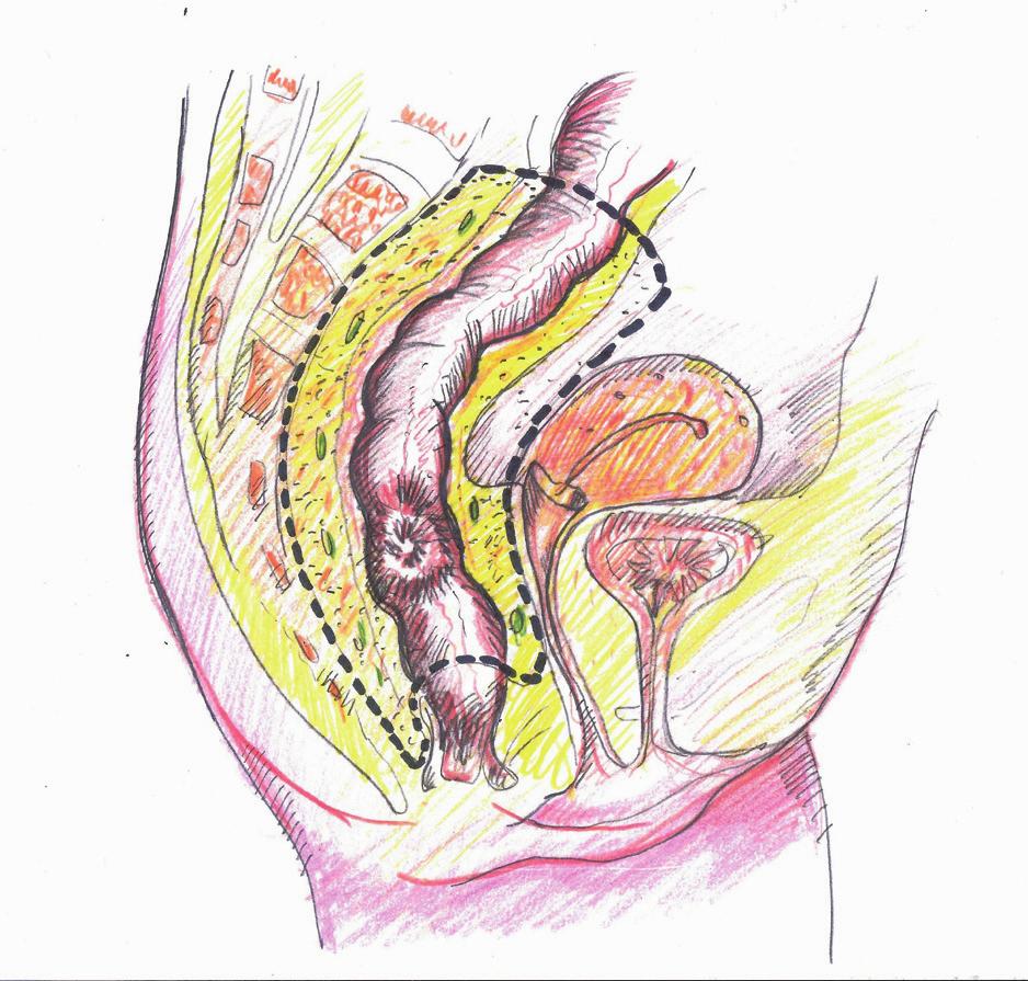 Chapter Figure : the left drawing depicts the gastrointestinal tract starting with the stomach, which becomes the small intestine (removed in this illustration), the colon and then the rectum and