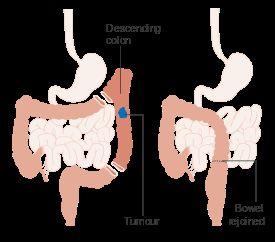 Examples of Colon Resections AP Resection Hemicolectomy Colon Cancer Treatments Surgery Colon resection