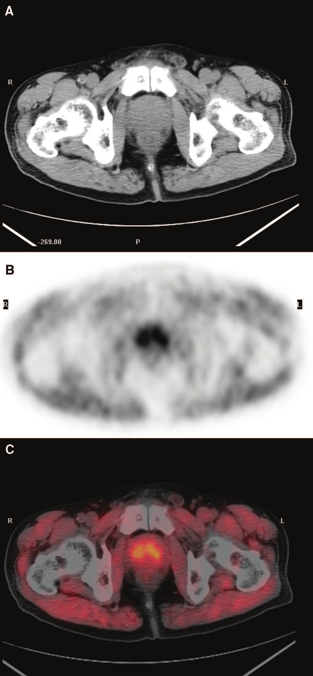Li et al Clinical Nuclear Medicine Volume 33, Number 10, October 2008 FIGURE 3. C-11 choline transaxial PET/CT image of a 70- year-old patient with BPH (PSA 5.42 g/l).