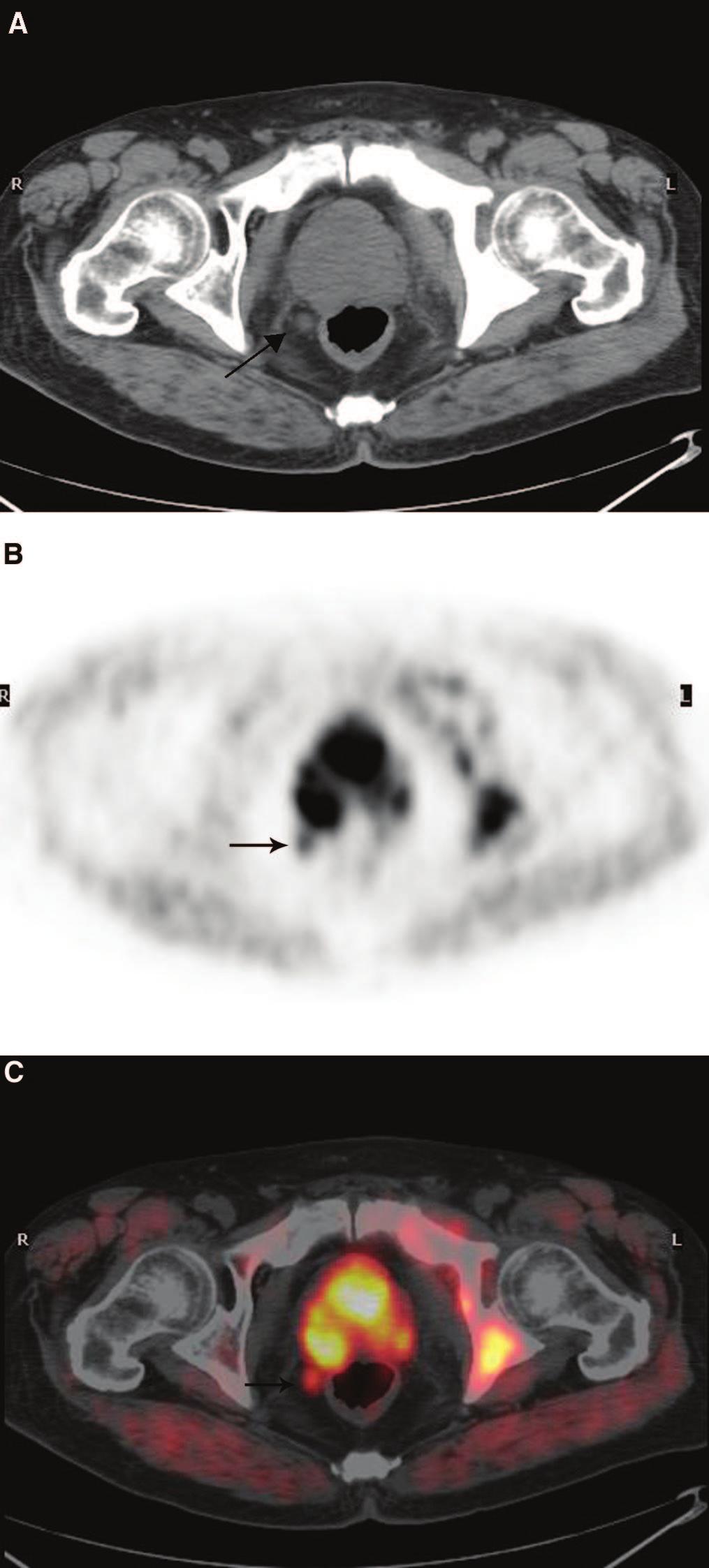 PET/CT image (C) shows symmetrical accumulation of radioactivity within the central zone of prostate. 674 FIGURE 4.