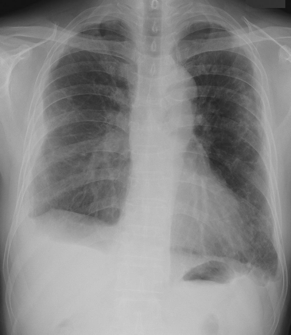 Fig. 4. Four months later from the initial chest radiogram, the disease has progressed with increased peripheral reticular nodular opacities and increased bilateral pleural effusion.