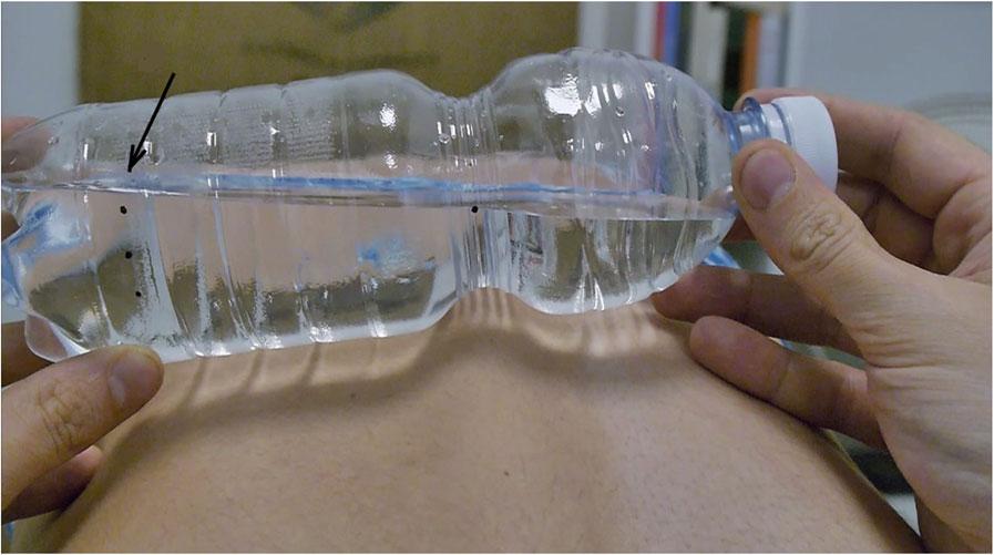 Tilt the bottle until it touches the patient s back (Fig. 4). Rotate the bottle until the surface of the water coincides with the position of landmark 1 (Fig. 5).
