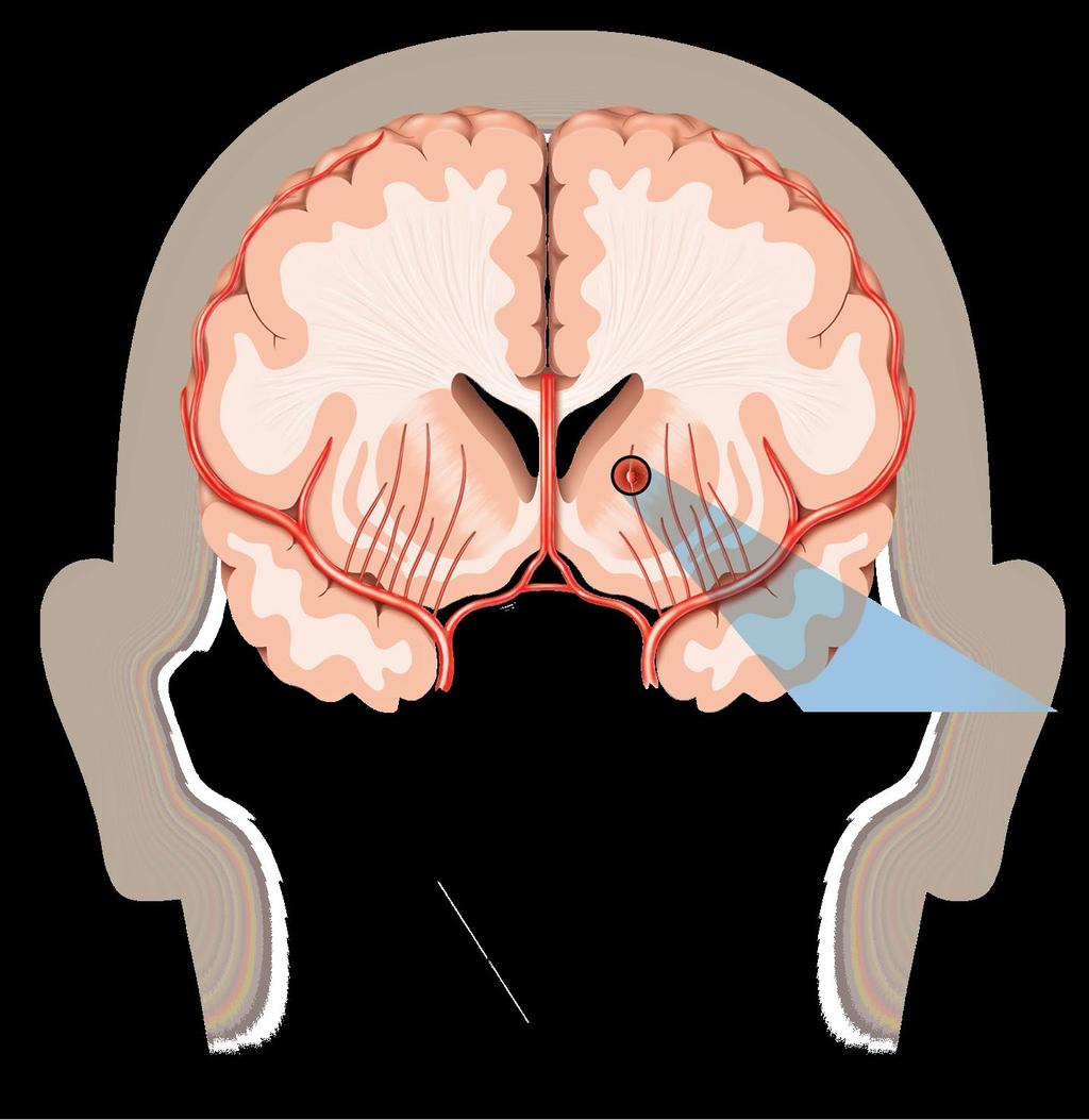 Intracerebral Hemorrhage Cerebral Hemorrhage Middle